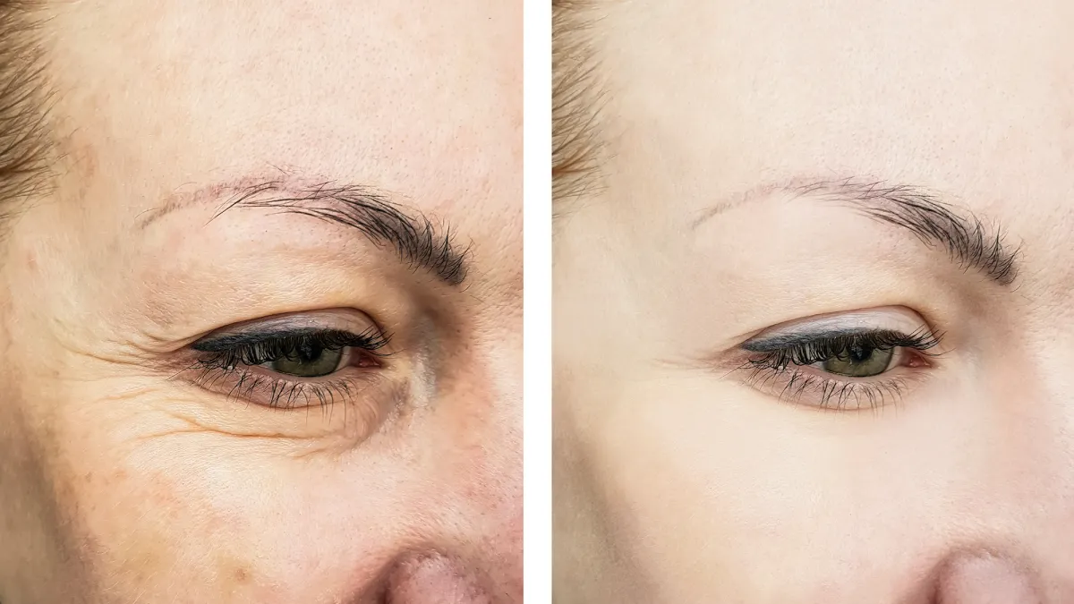 Wrinkle-Treatment-Stock-Photo