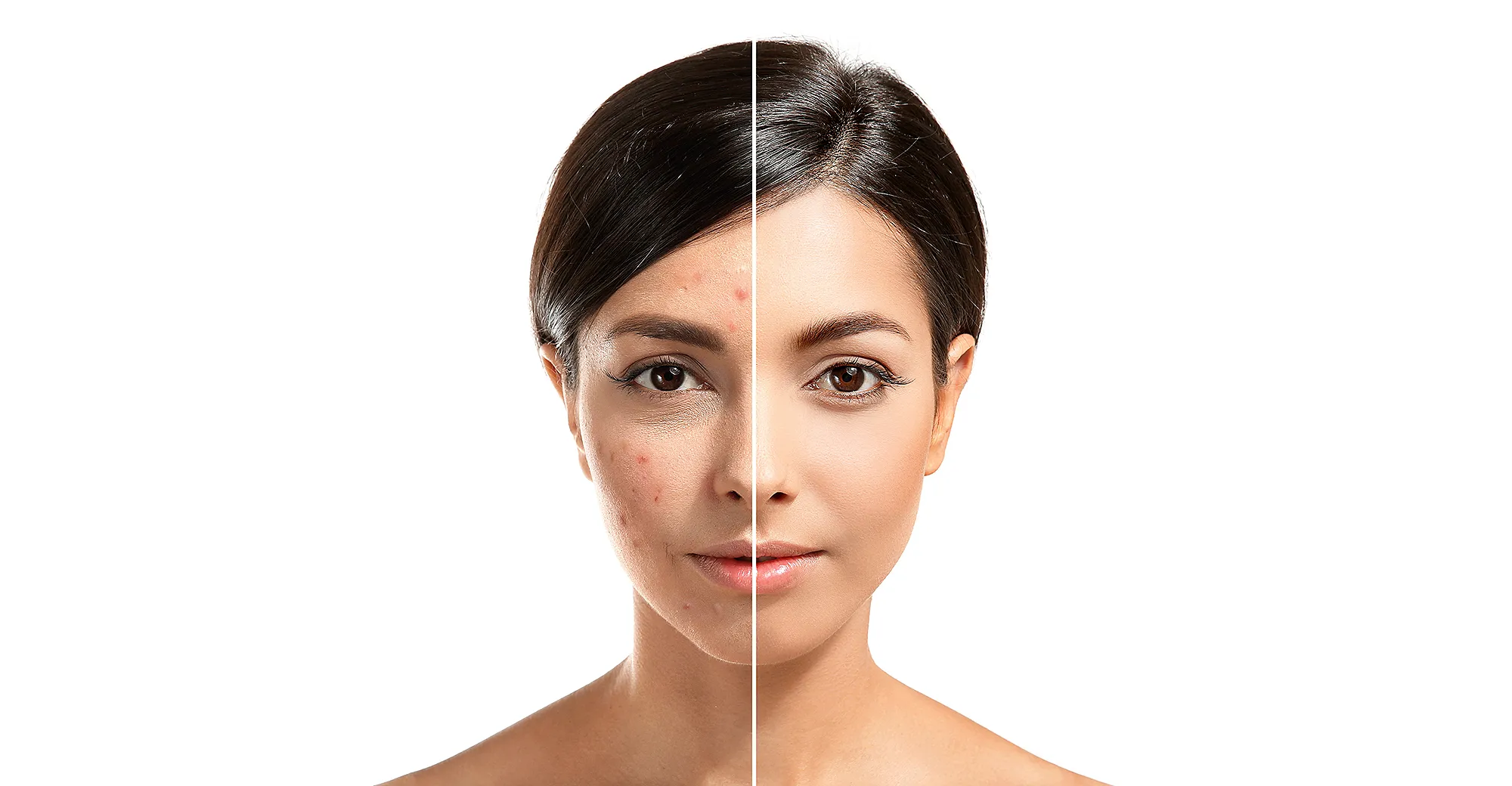 acne-elixir-pimple-before-after