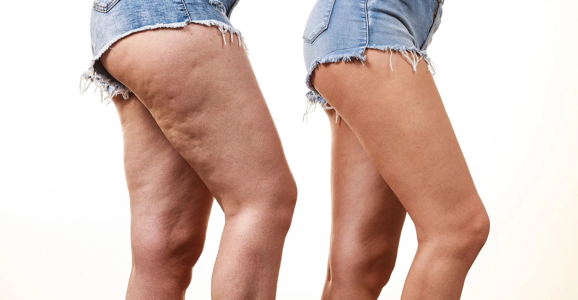cellulite-before-after