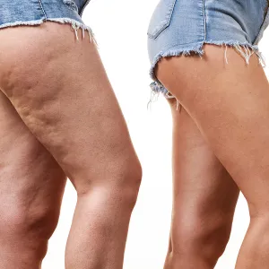 cellulite-before-after