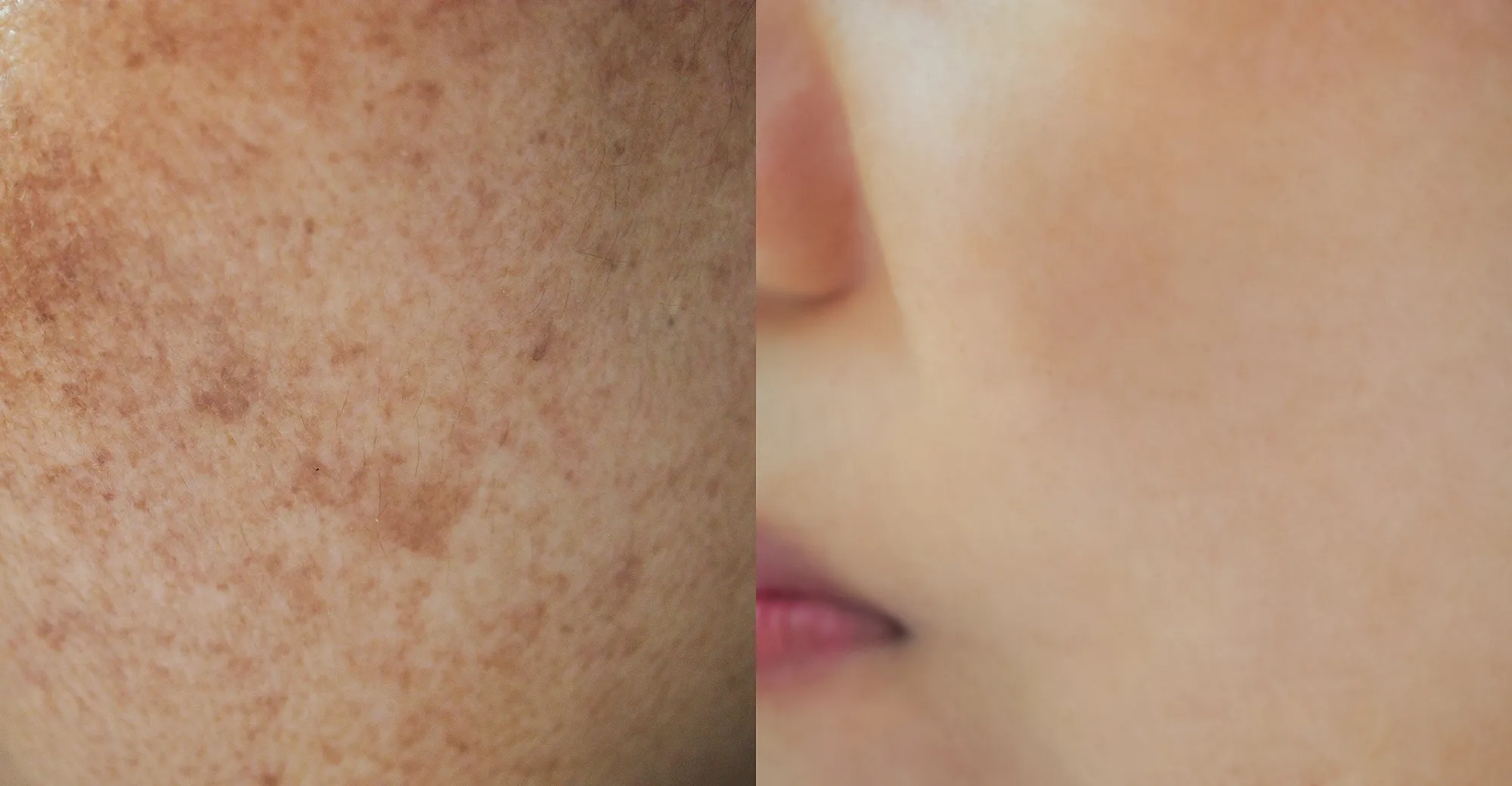 dark-spots-before-after