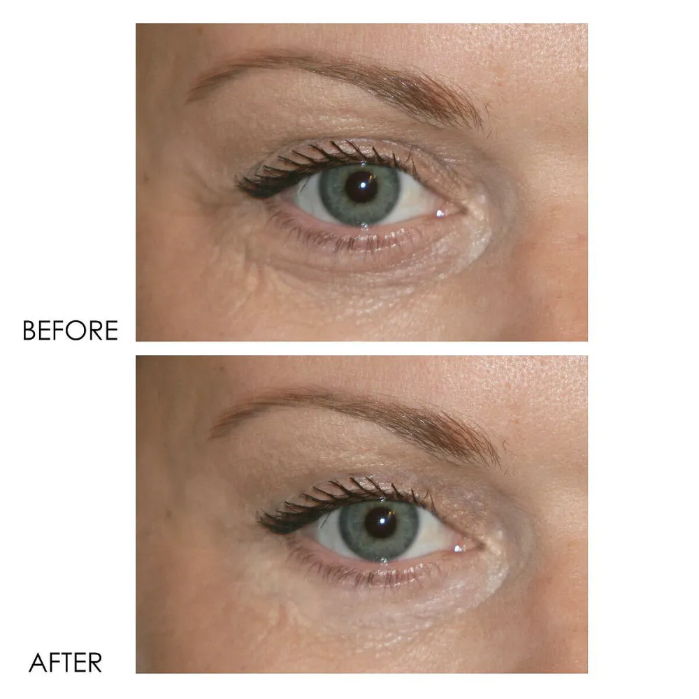 dermelect-eye-cream-before-after