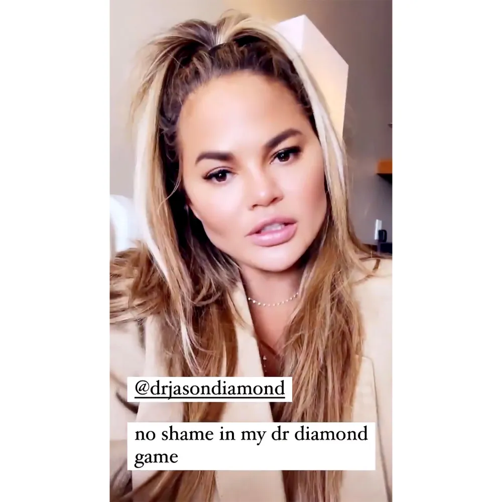 Chrissy Teigen Reveals the Results of &lsquo;Fat Removal&rsquo; Surgery on Her Face