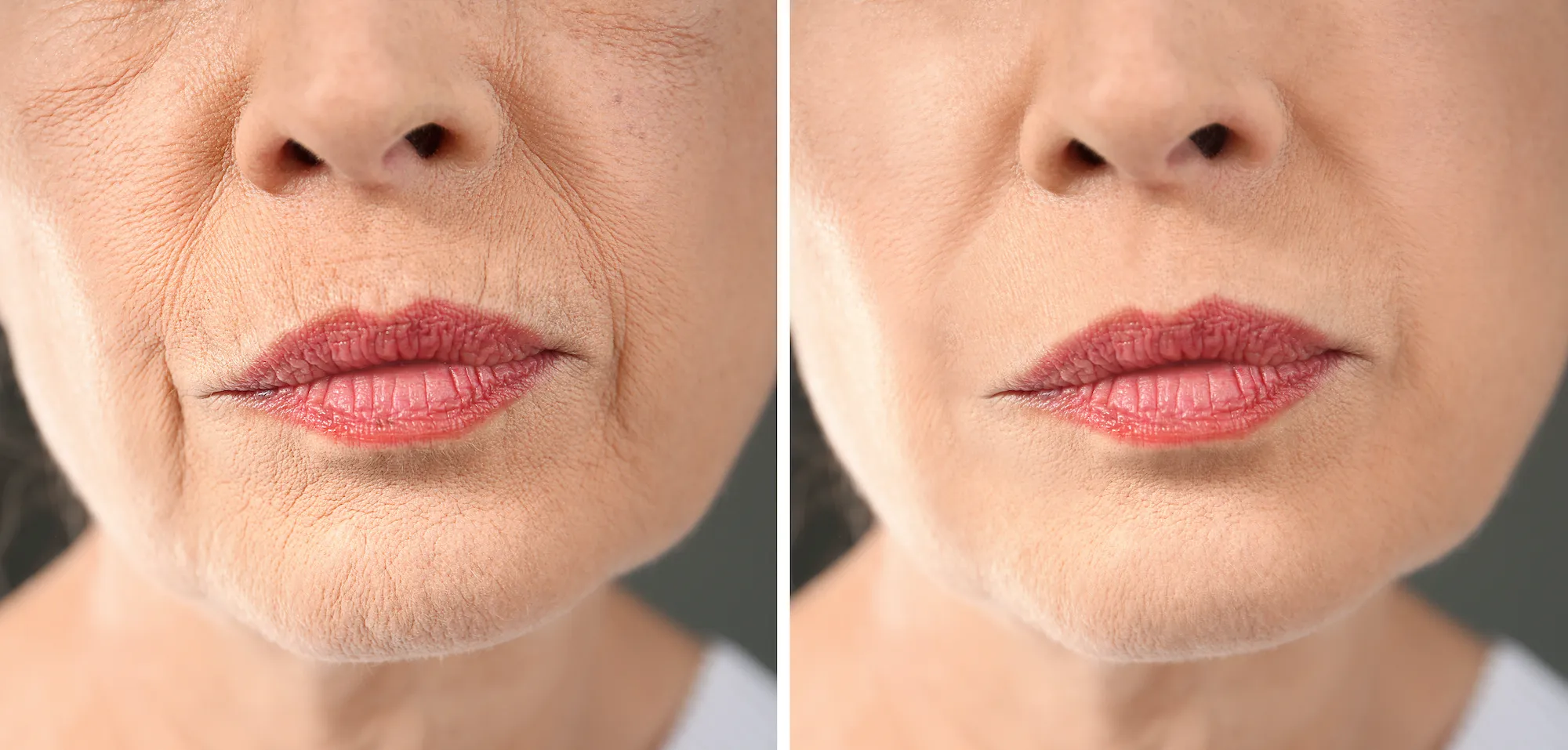 Upper-Lip-Treatment