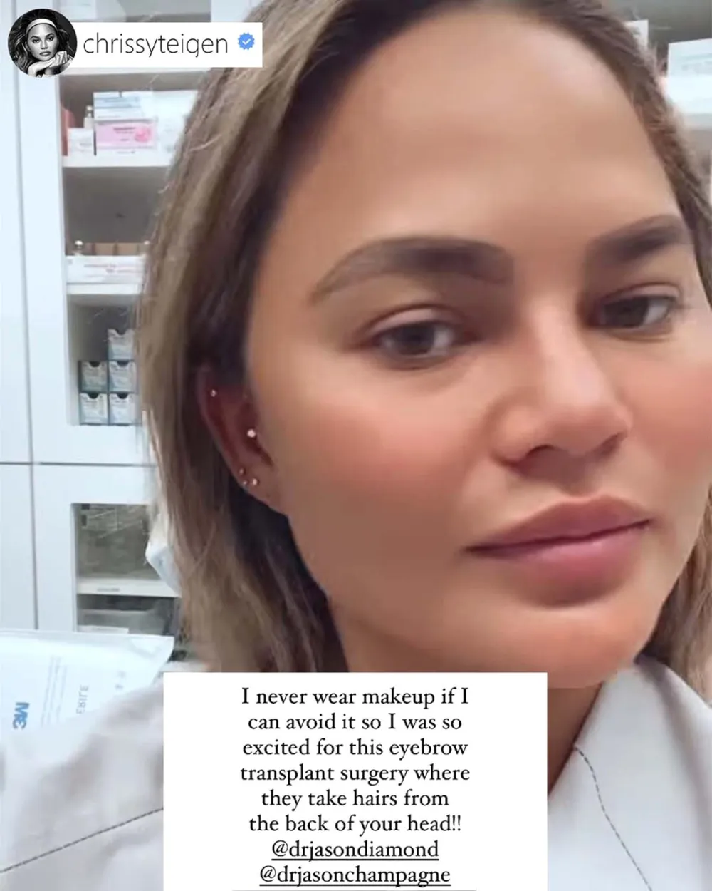 Chrissy Teigen Reveals She Had Eyebrow Transplant Surgery