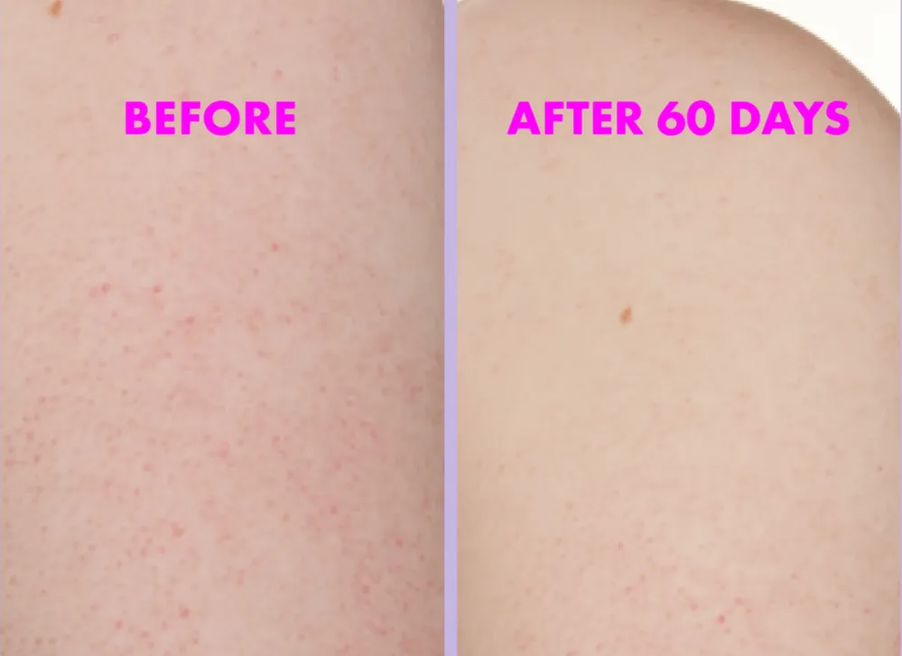 KP Body Bumps Be Gone