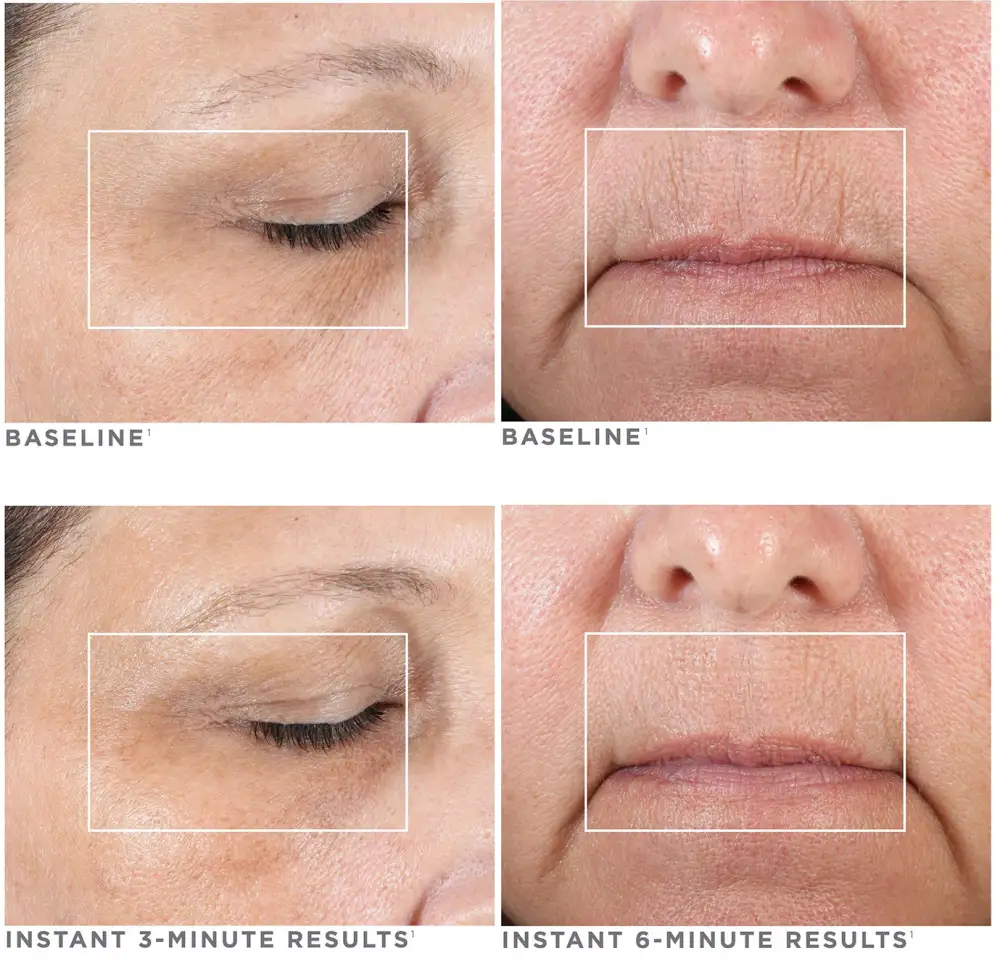 NuFACE FIX&reg; Line Smoothing Device Kit