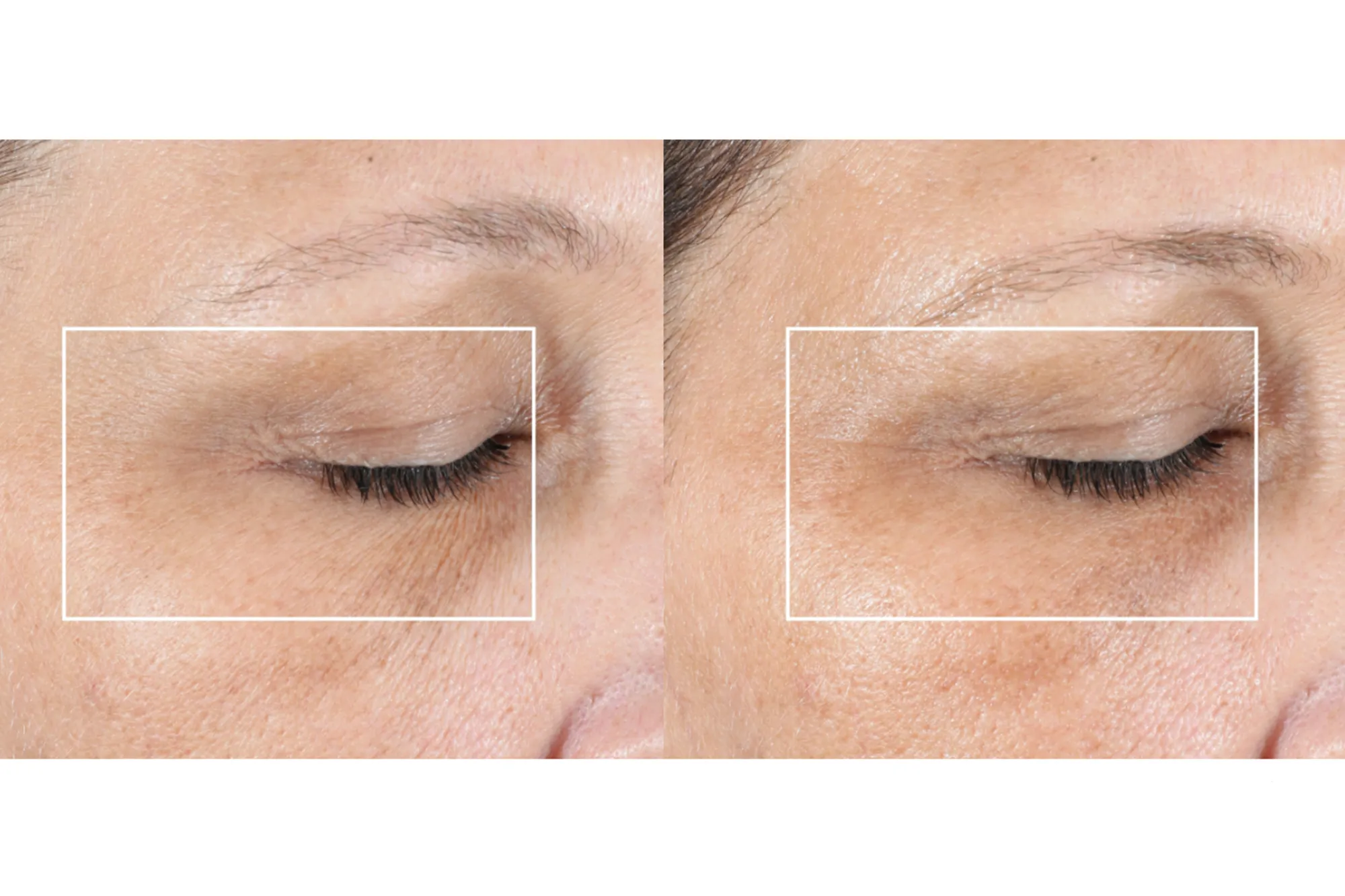 NuFACE FIX® Line Smoothing Device Kit