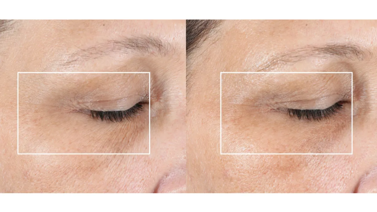 NuFACE FIX® Line Smoothing Device Kit