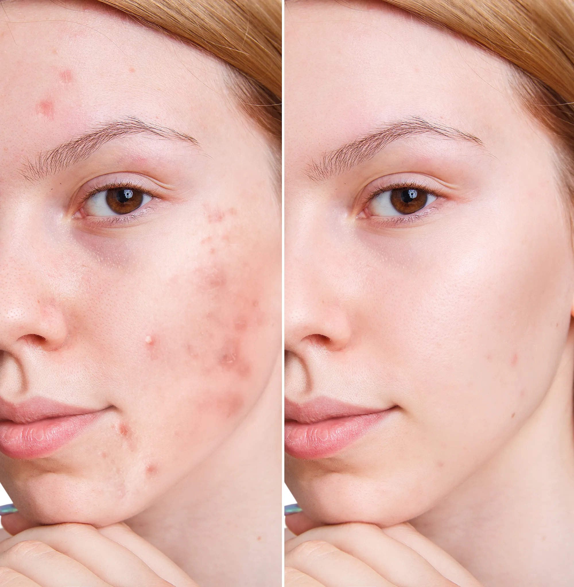acne-before-after