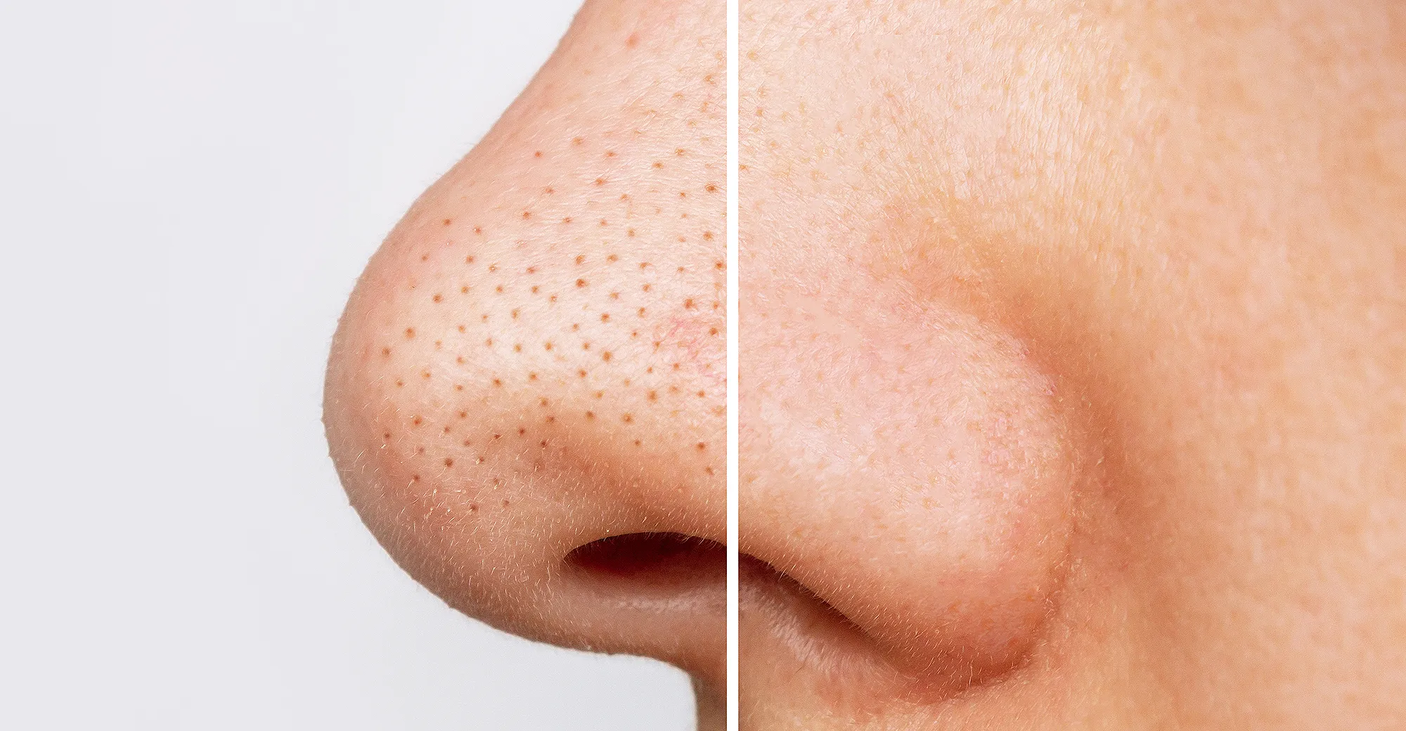 blackheads-before-after-mario-badescu-silver-powder