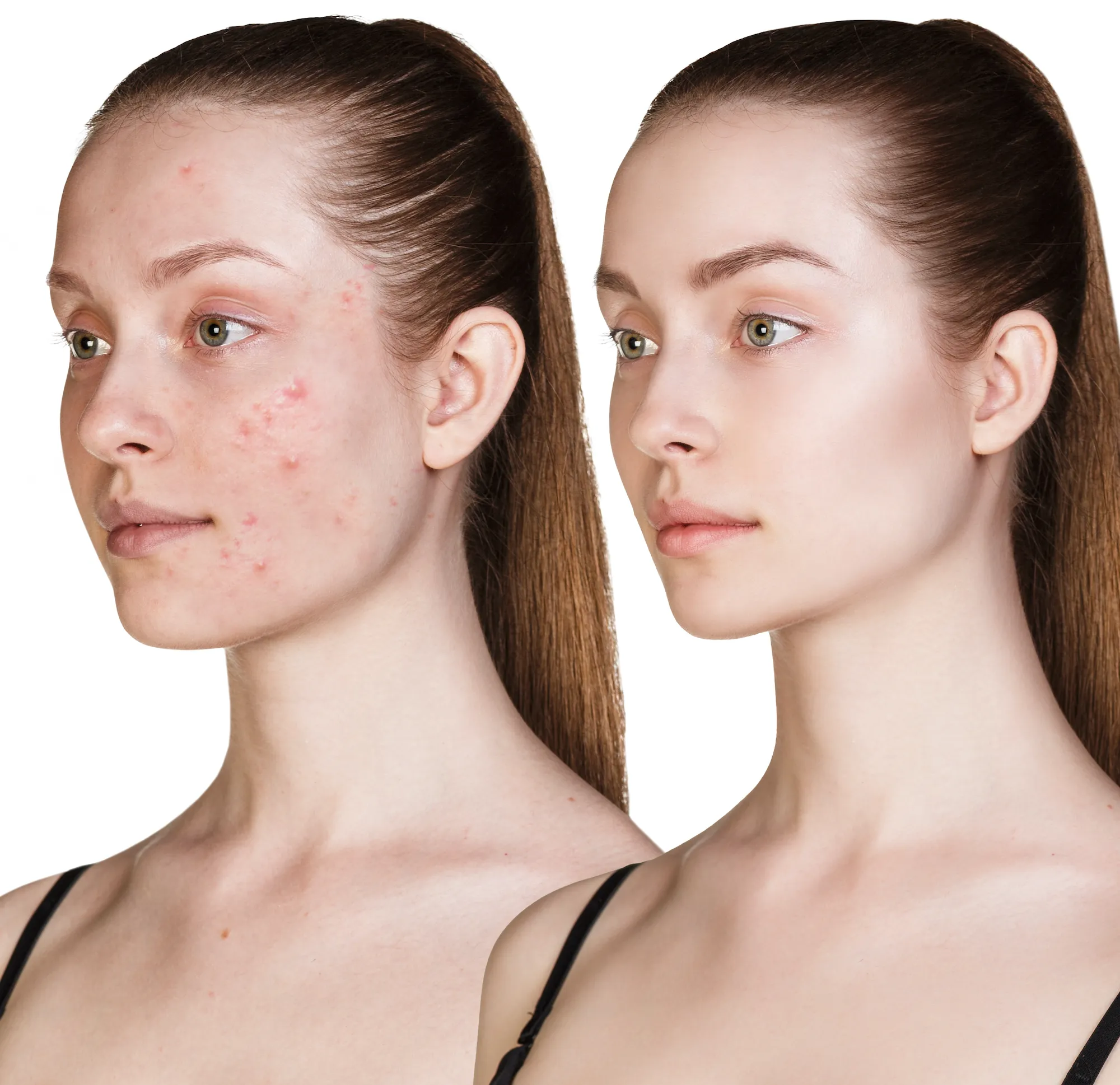 Before-After-Acne-Treatment-Stock-Photo