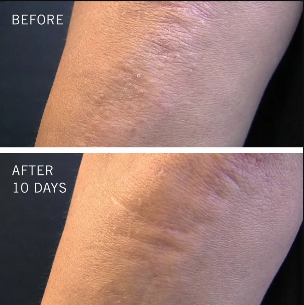 First Aid Beauty KP Bump Eraser Body Scrub with 10 AHA