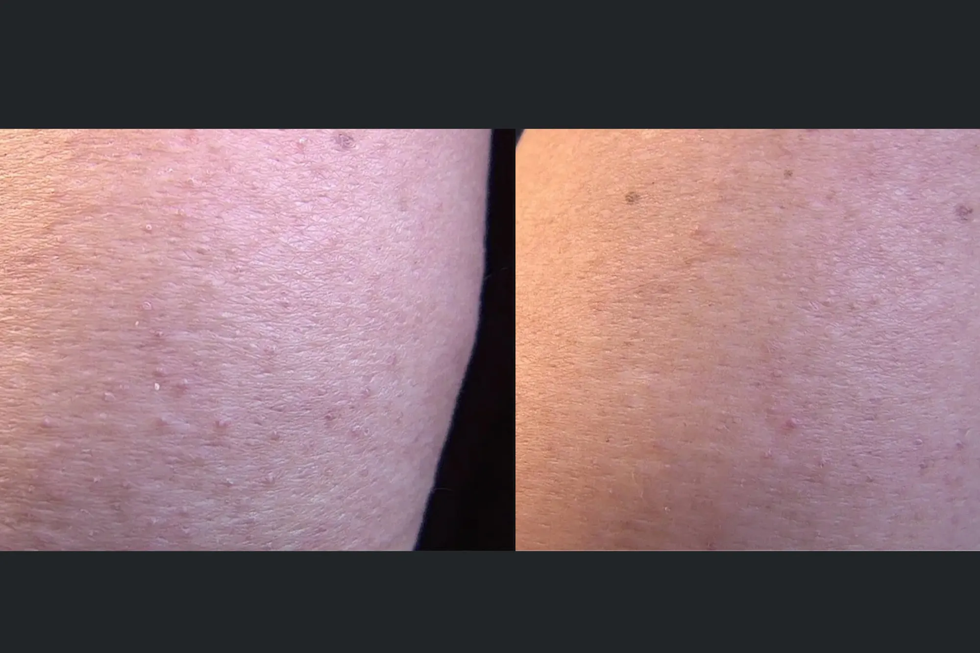 First Aid Beauty KP Bump Eraser Body Scrub with 10 AHA