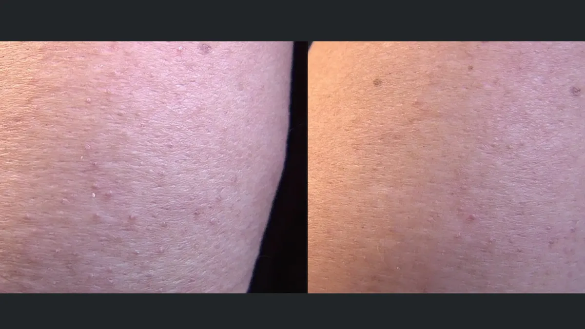 First Aid Beauty KP Bump Eraser Body Scrub with 10 AHA