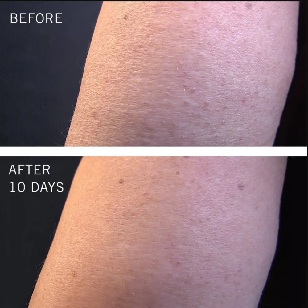 First Aid Beauty KP Bump Eraser Body Scrub with 10 AHA