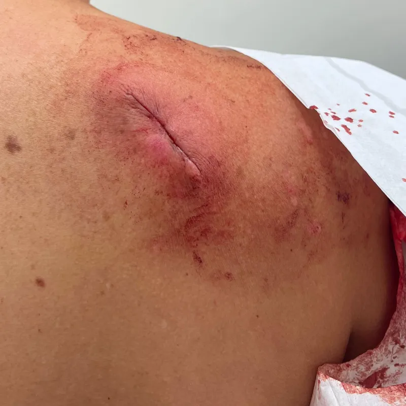 RHOBH Teddi Mellencamp Has a Skin Cancer Scare 3