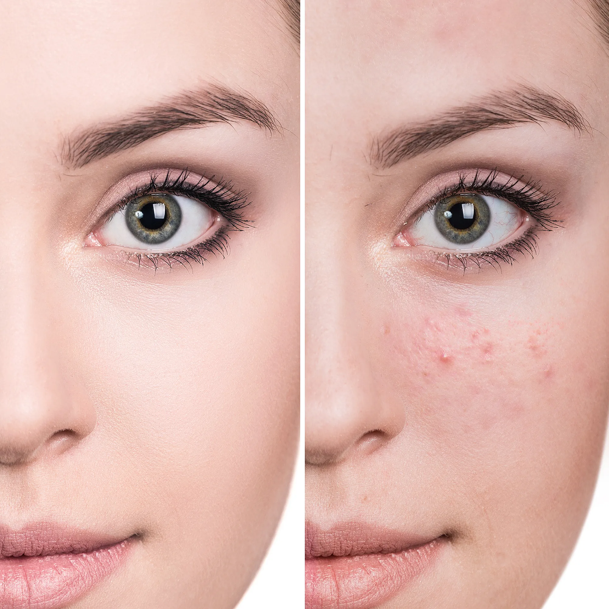 acne-breakouts-before-after