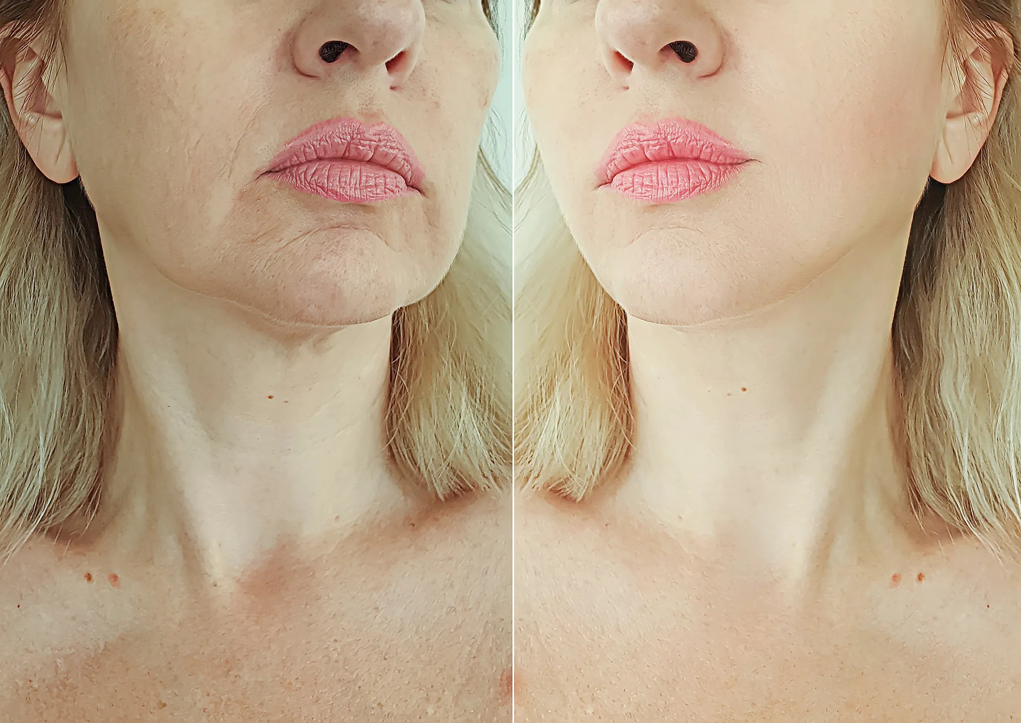 neck-cream-before-after