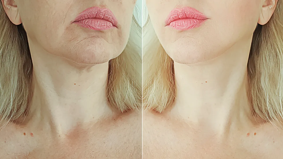 neck-cream-before-after