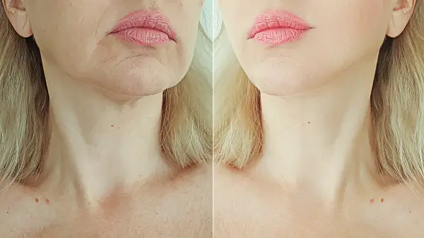 neck-cream-before-after