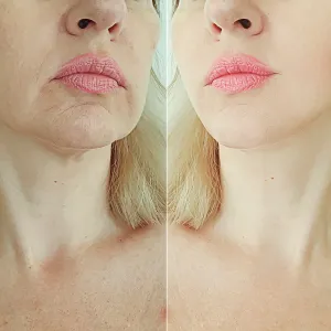 neck-cream-before-after