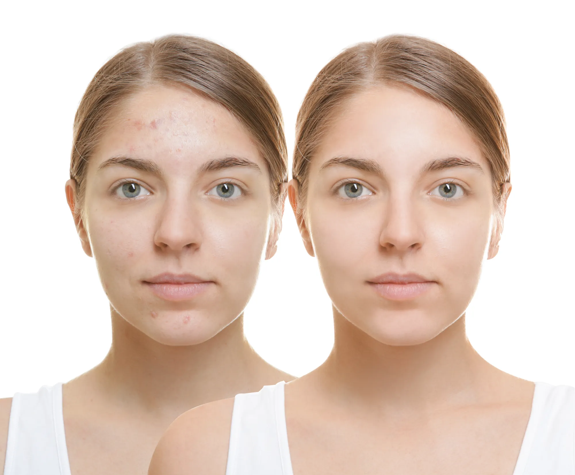Before-After-Acne-Scarring-Stock-Photo