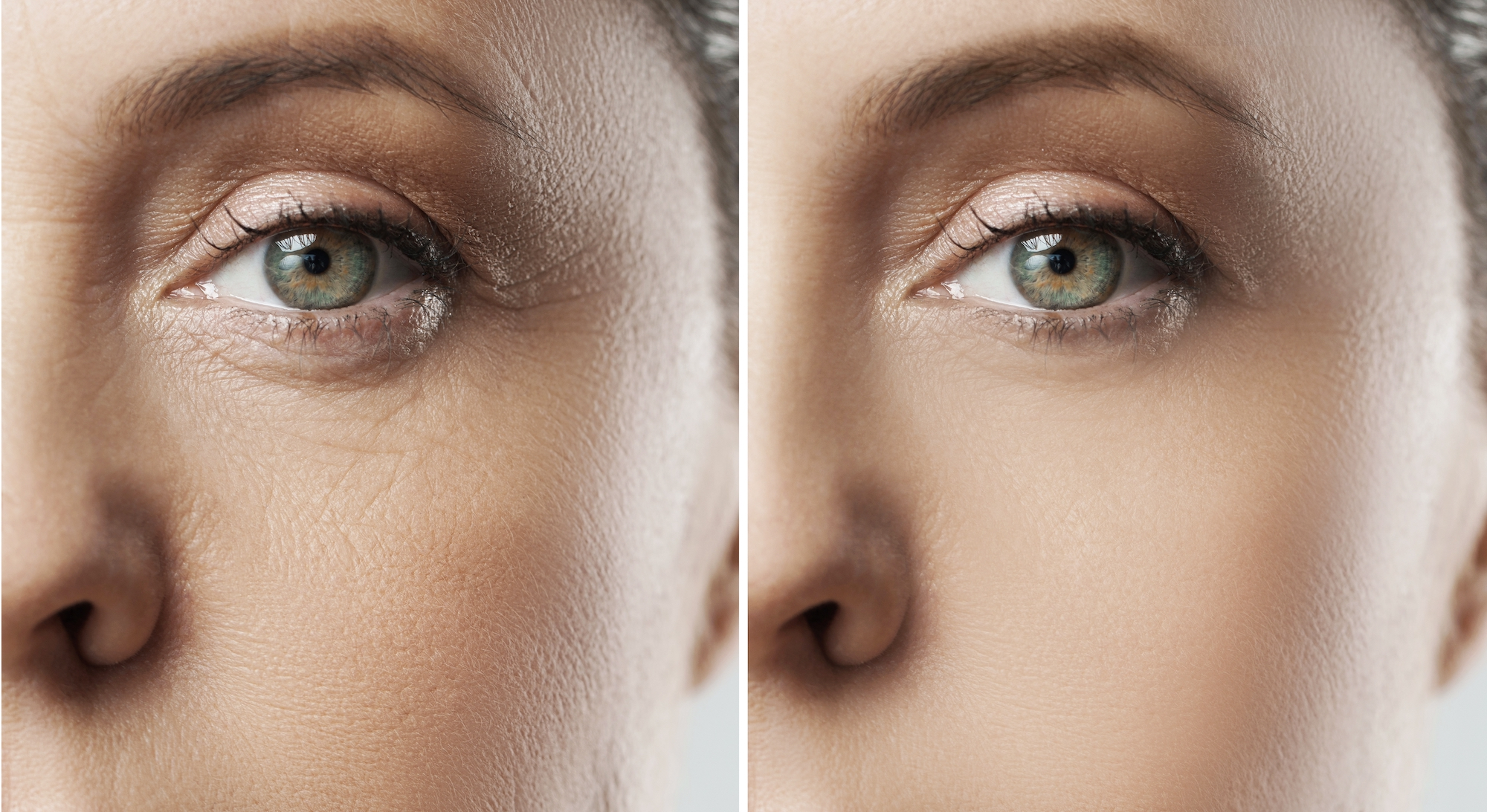 Before-After-Wrinkle-Treatment-Stock-Photo