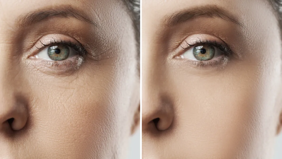 Before-After-Wrinkle-Treatment-Stock-Photo