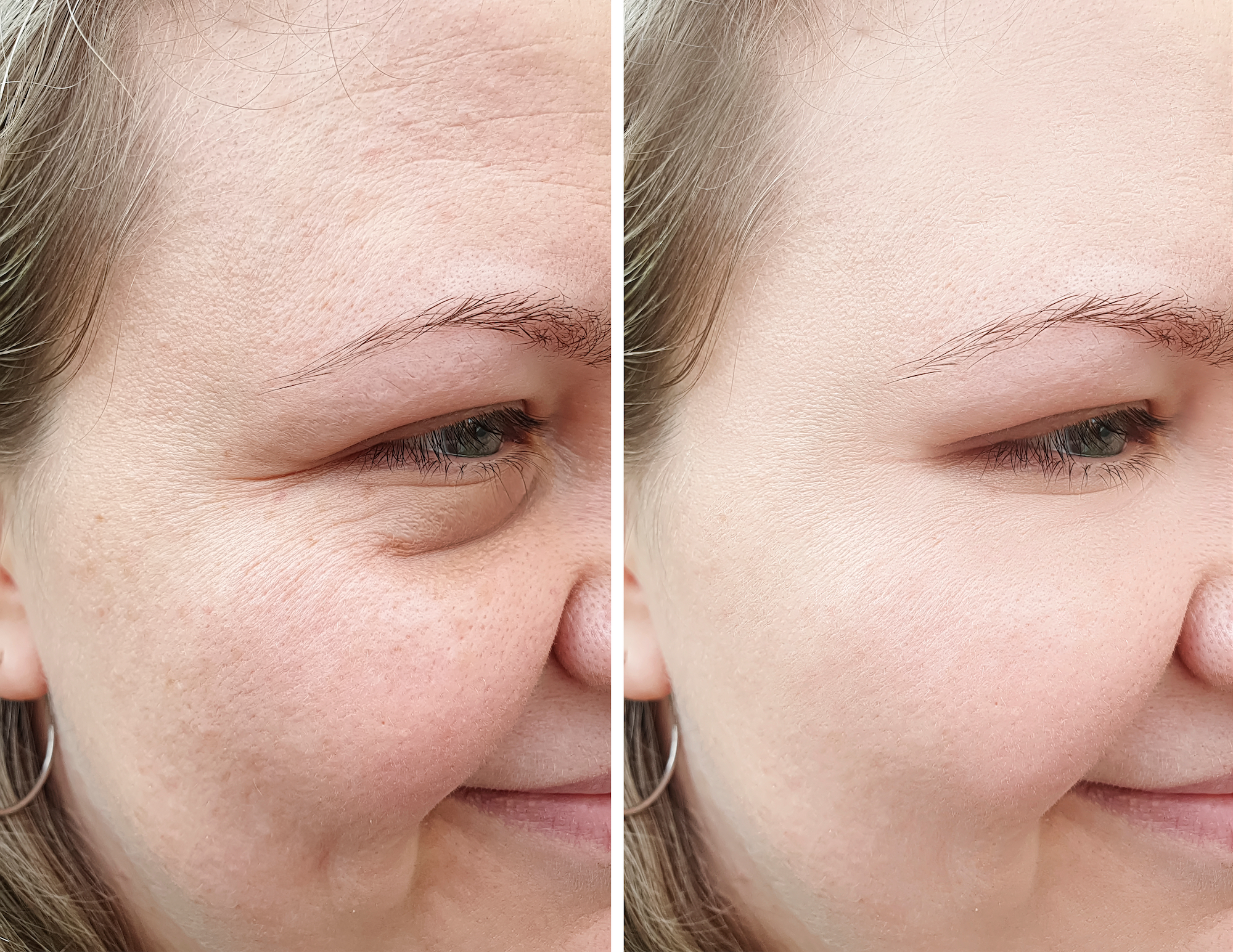 Before-and-After-Skin-Treatment-Stock-Photo