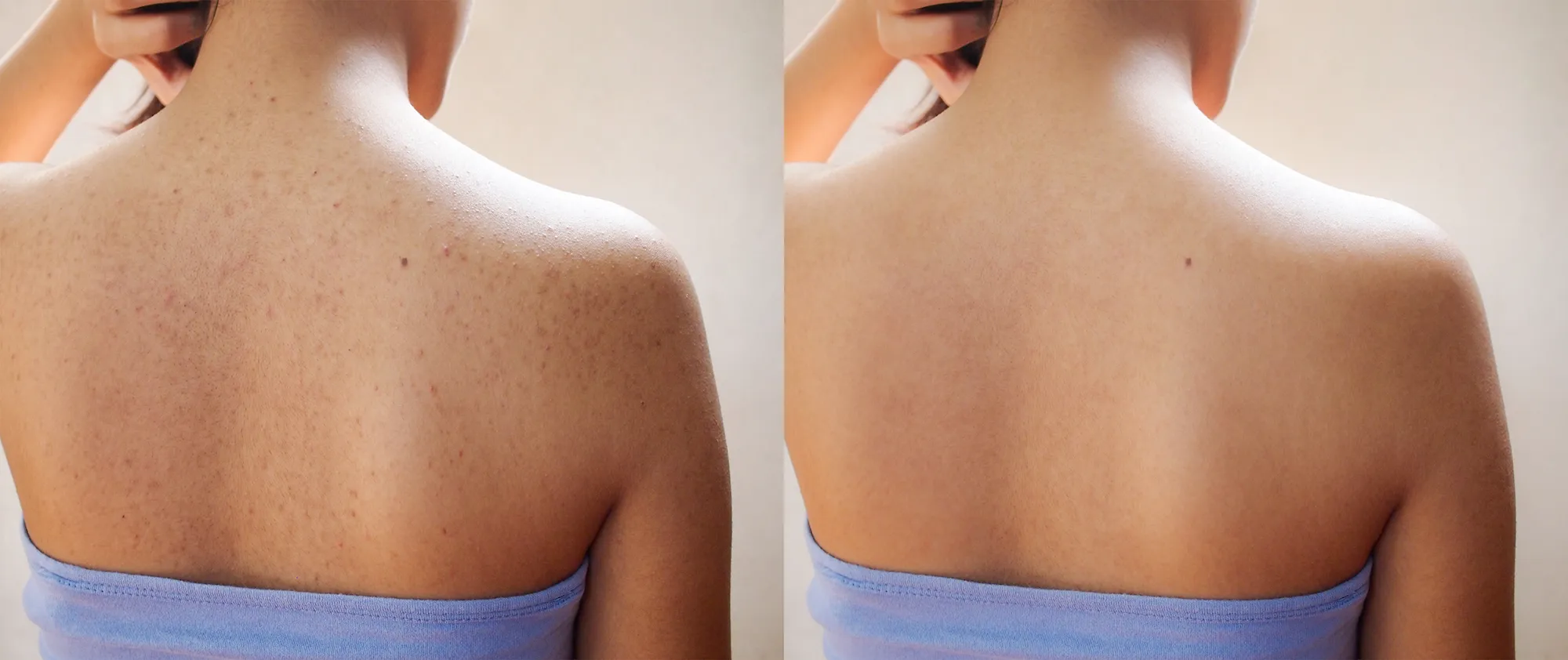 best-body-wash-for-acne-before-after