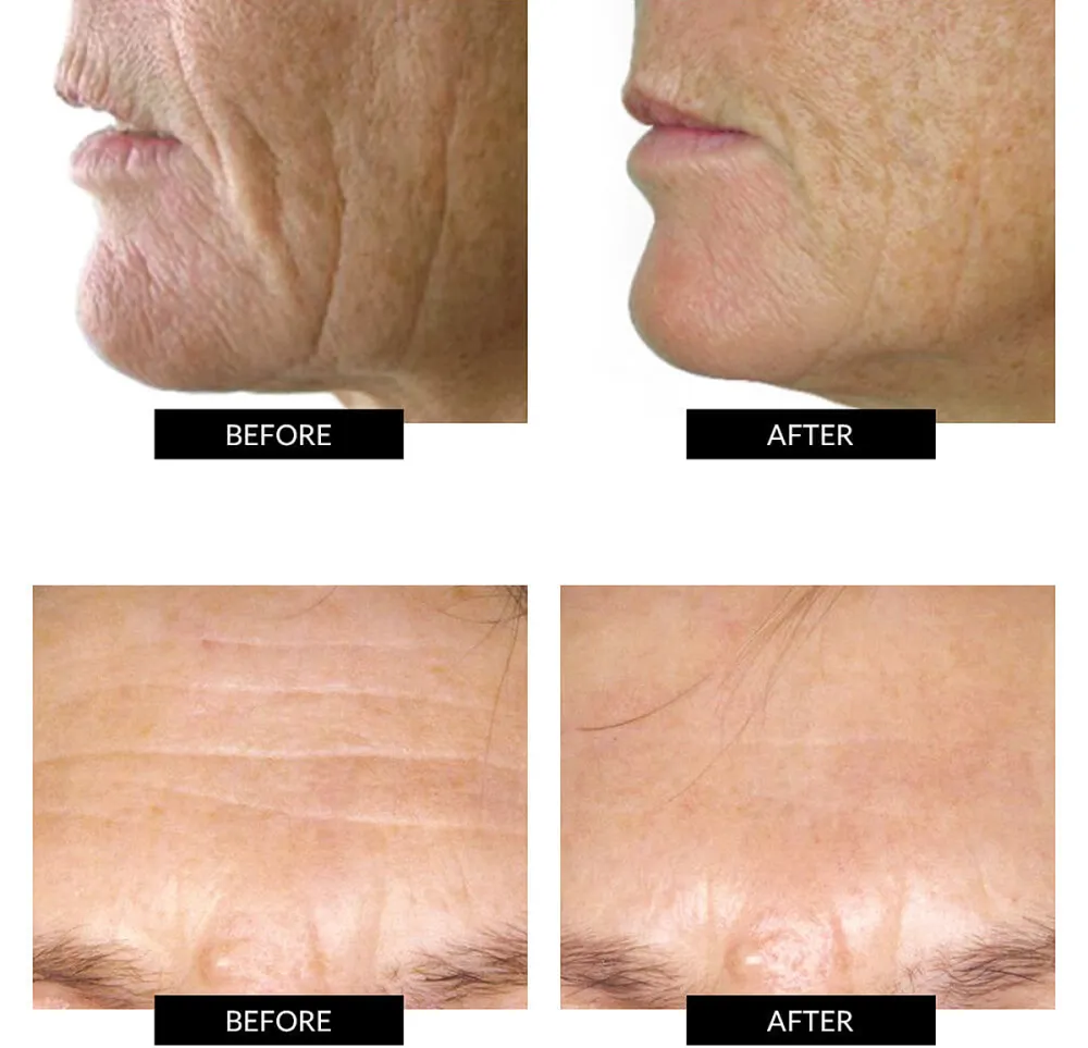 currentbody-led-mask-before-after