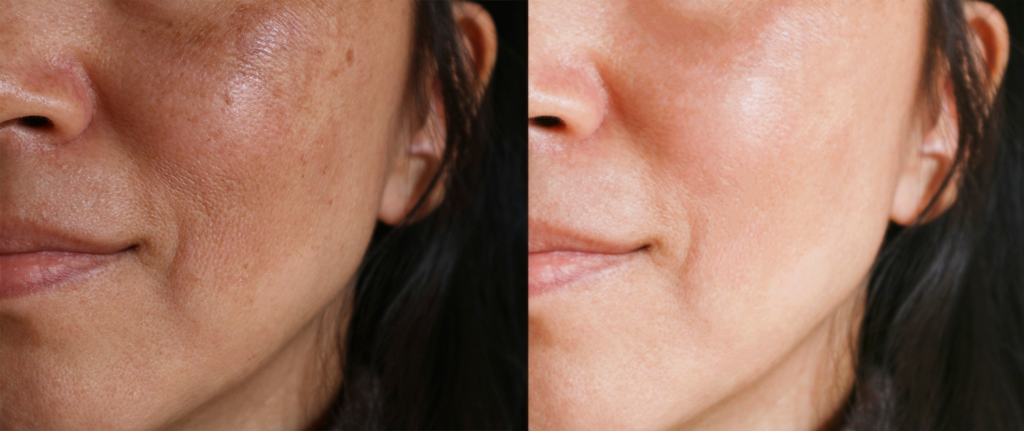 Brightening-Treatment-Before-After
