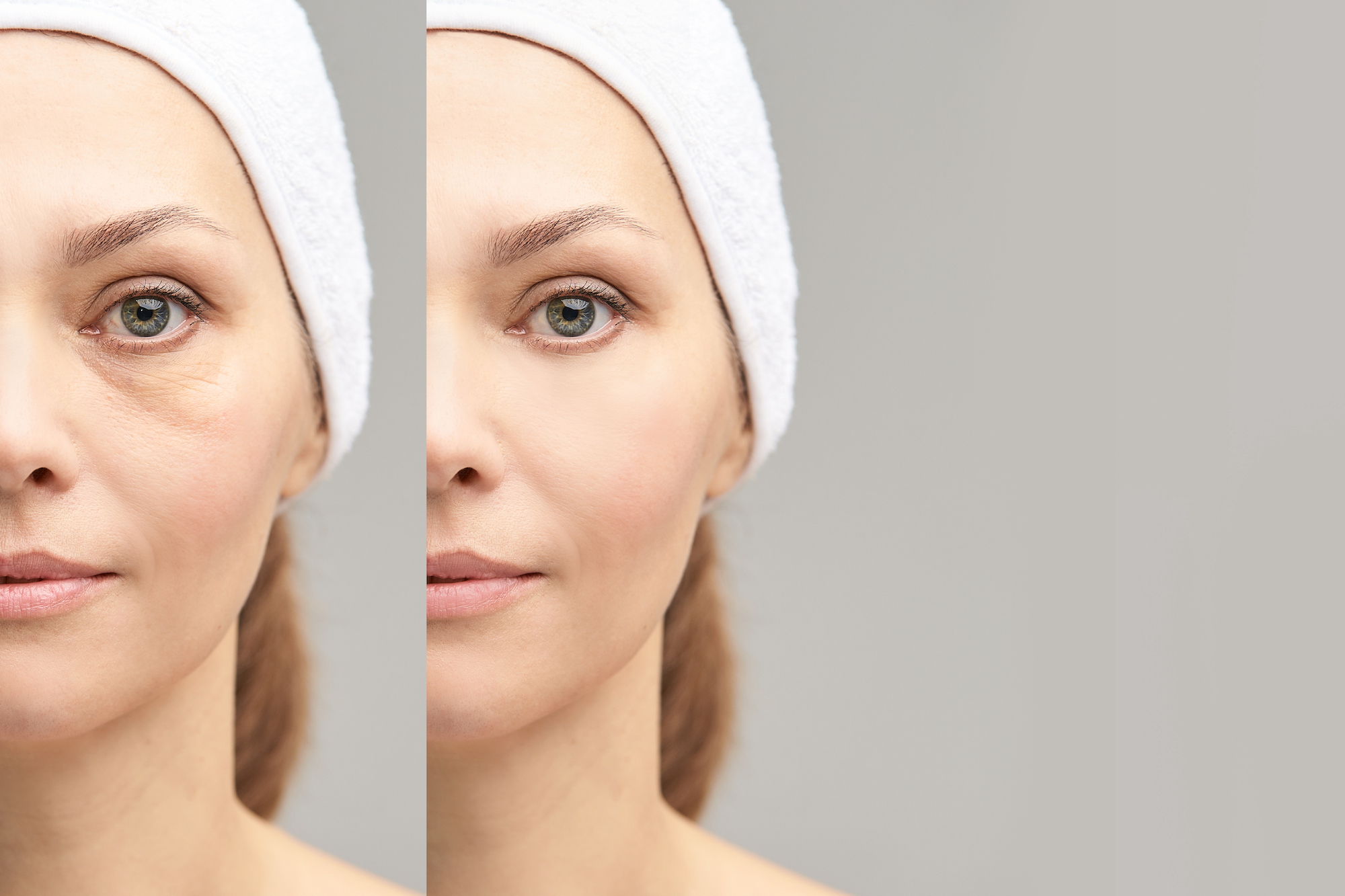 Puffy-Eyes-Before-After-Stock-Photo