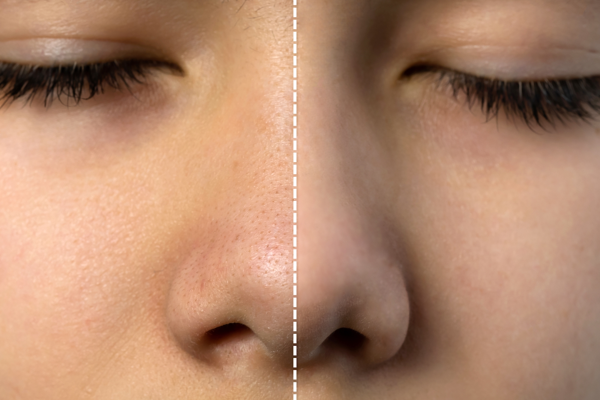 Before-After-Pore-Treatment-Stock-Photo