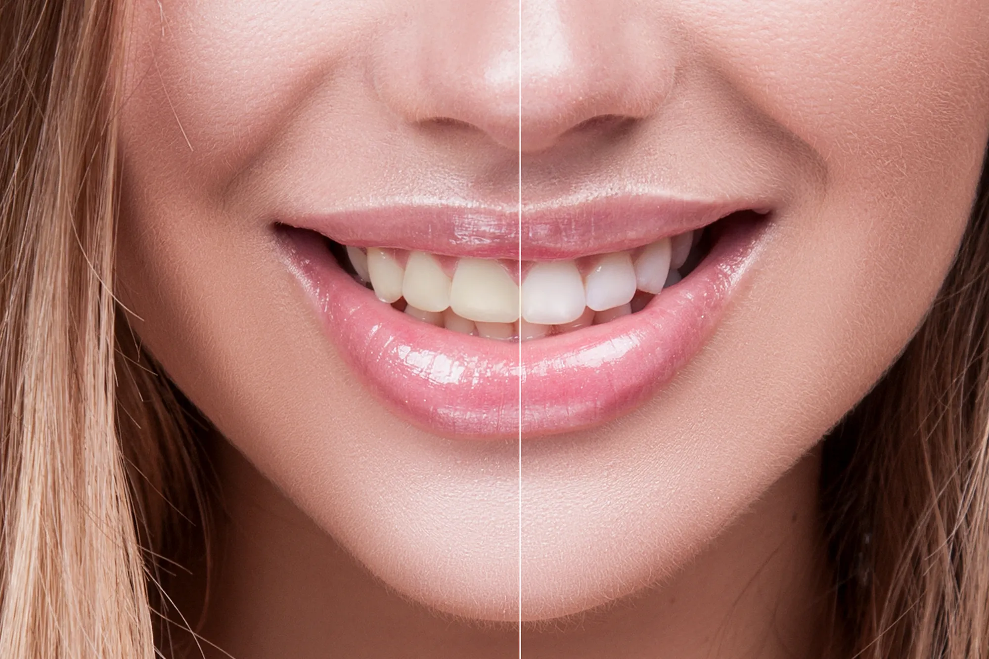 Before-After-Teeth-Whitening-Stock-Photo