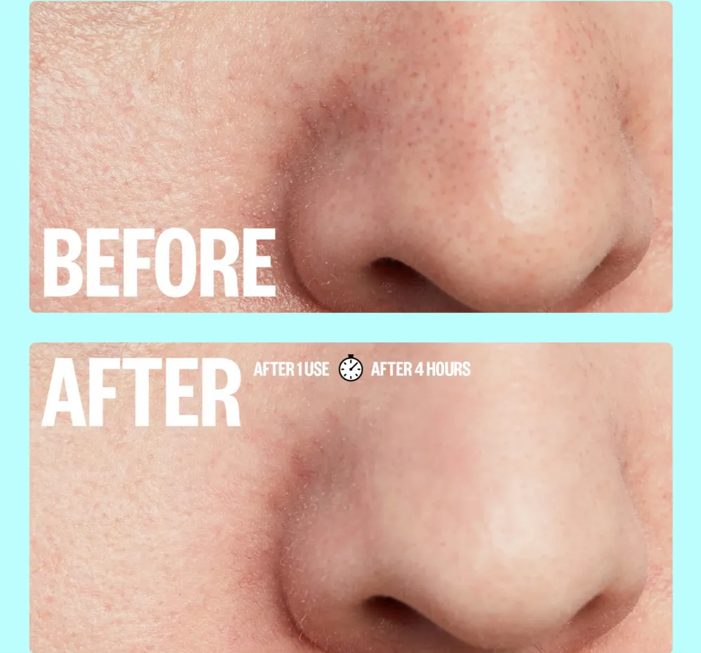 Oil-Absorbing Pore Strips