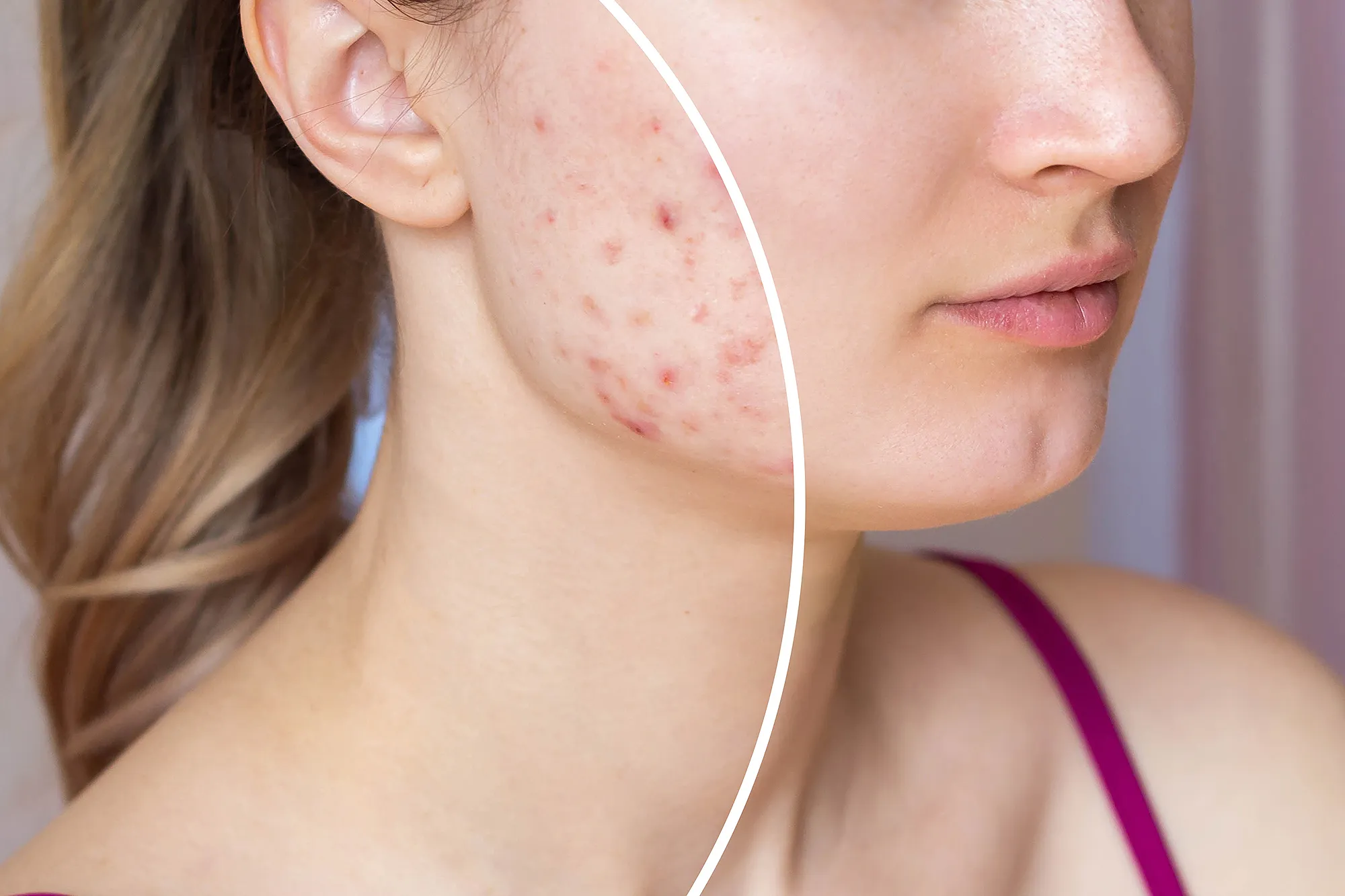 amazon-prime-day-acne-pimple-patches-before-after