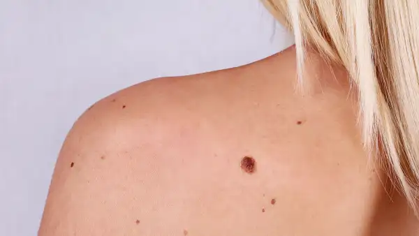 skin-tag-remover-amazon