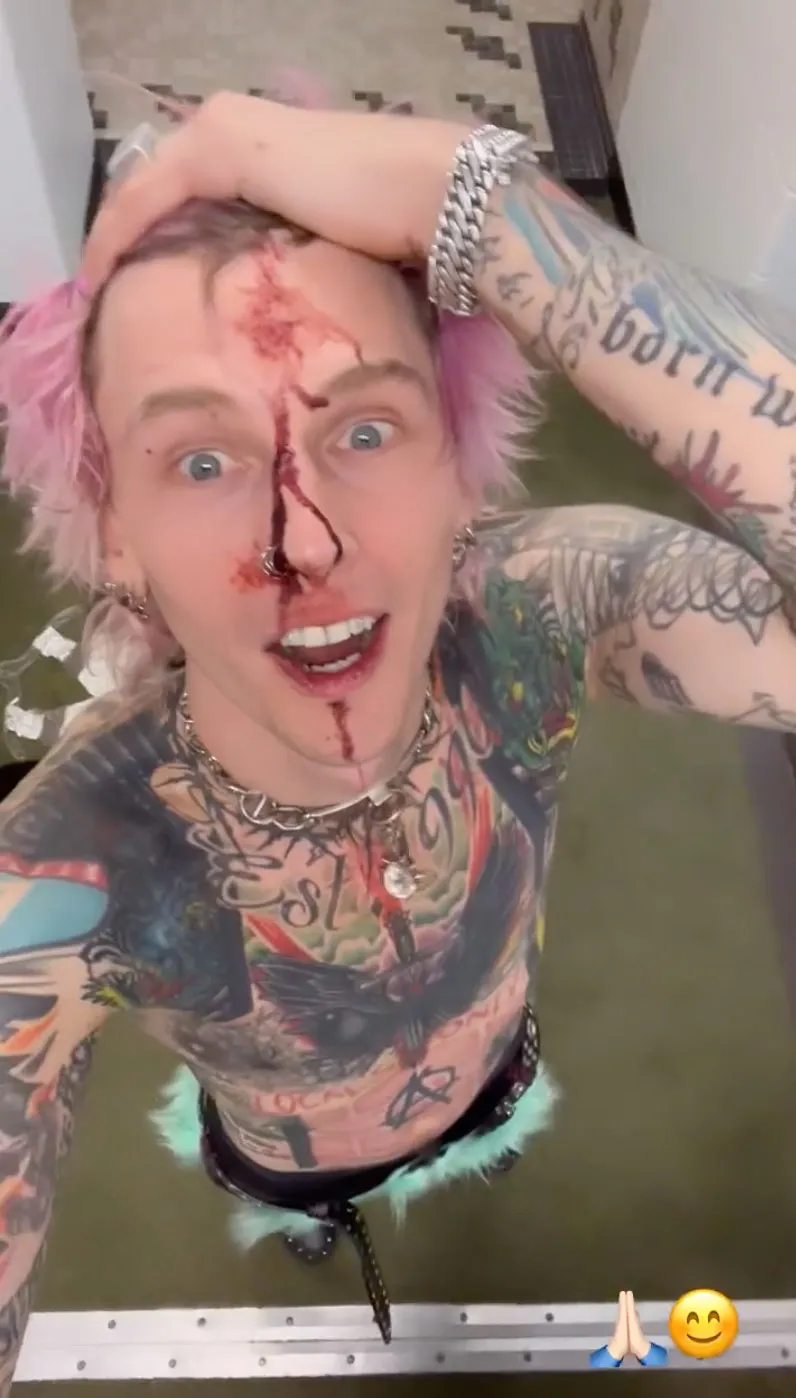 Machine Gun Kelly Shows Off Bloody Face After F&ndash;king Insane Cleveland Concert