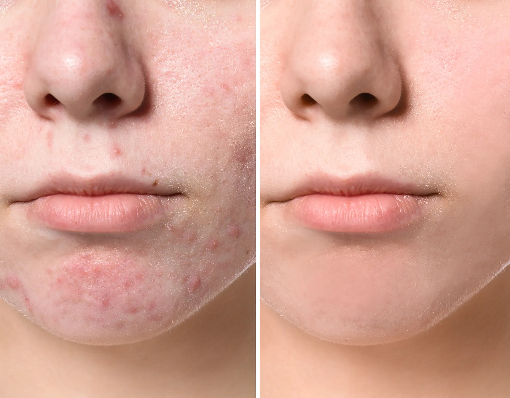 acne-before-after