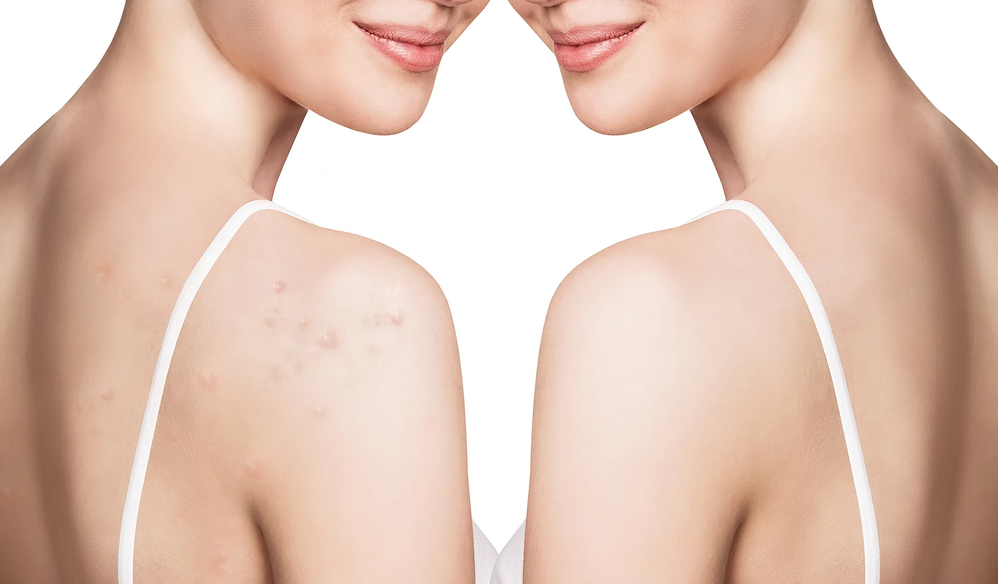 paulas-choice-acne-body-spray-backne