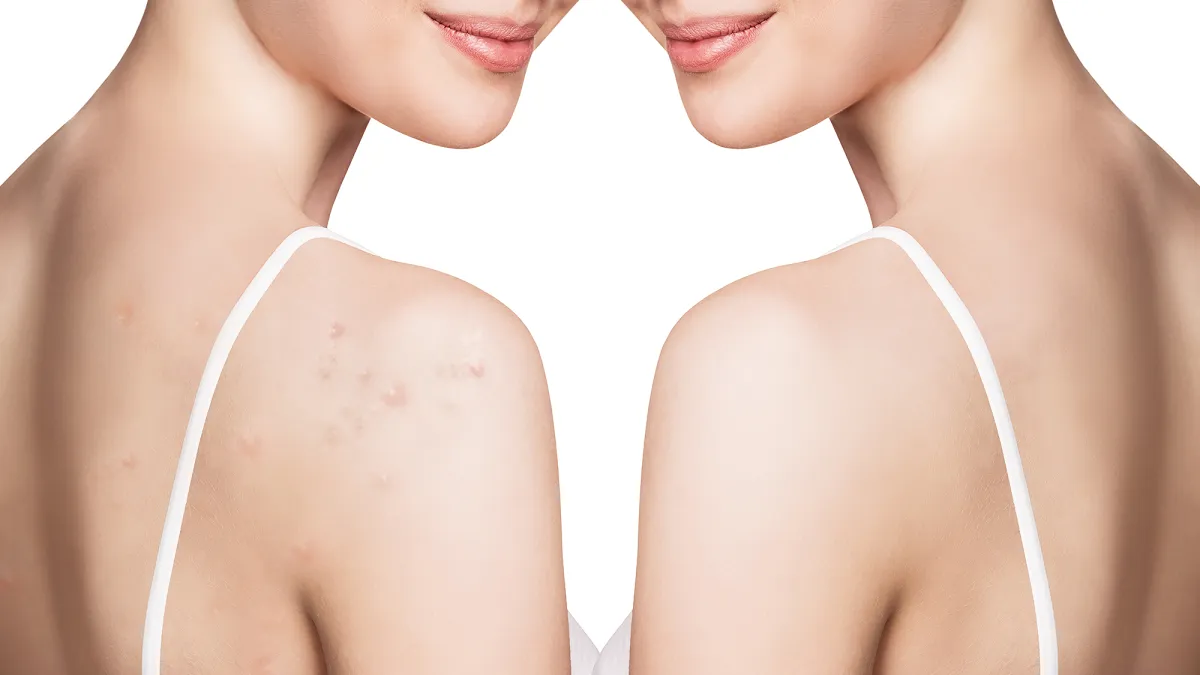 paulas-choice-acne-body-spray-backne