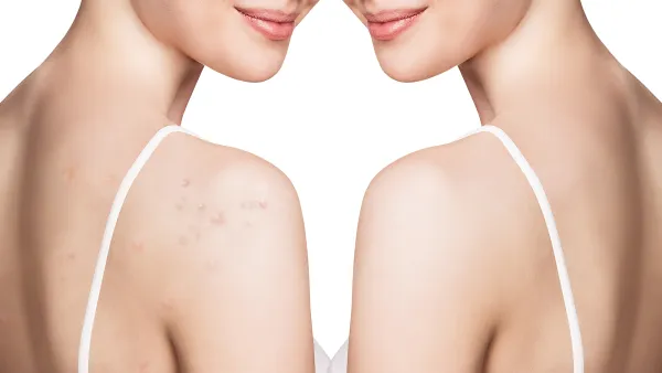 paulas-choice-acne-body-spray-backne