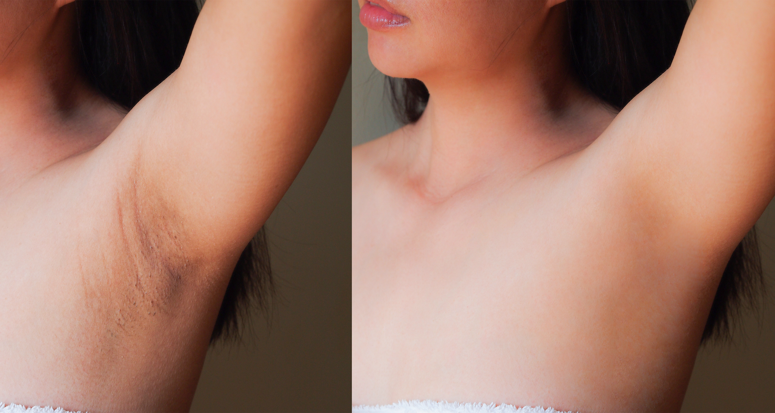 Dark-Spot-Correction-Before-After