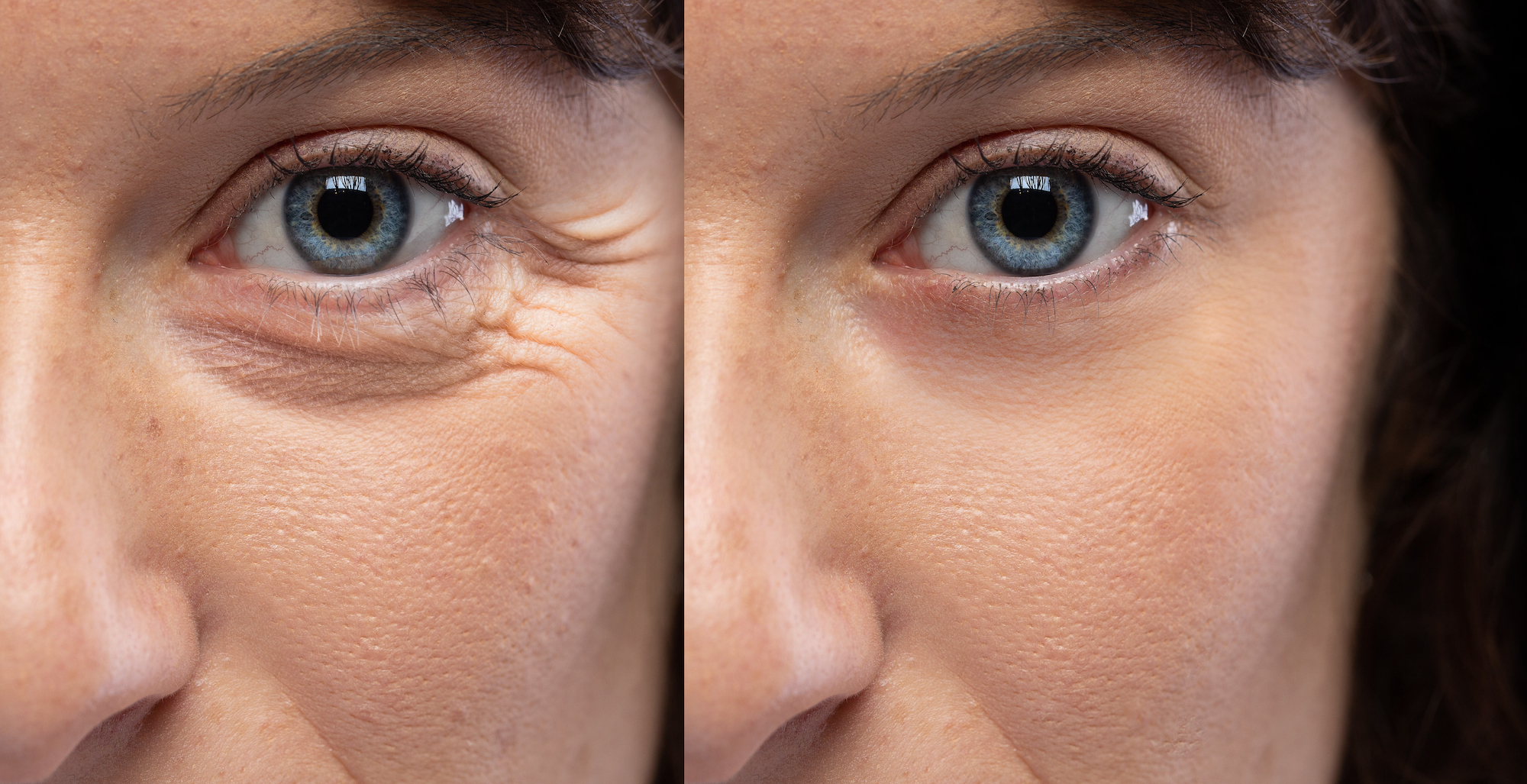 before-After-Crows-Feet-Treatment-Stock-Photo