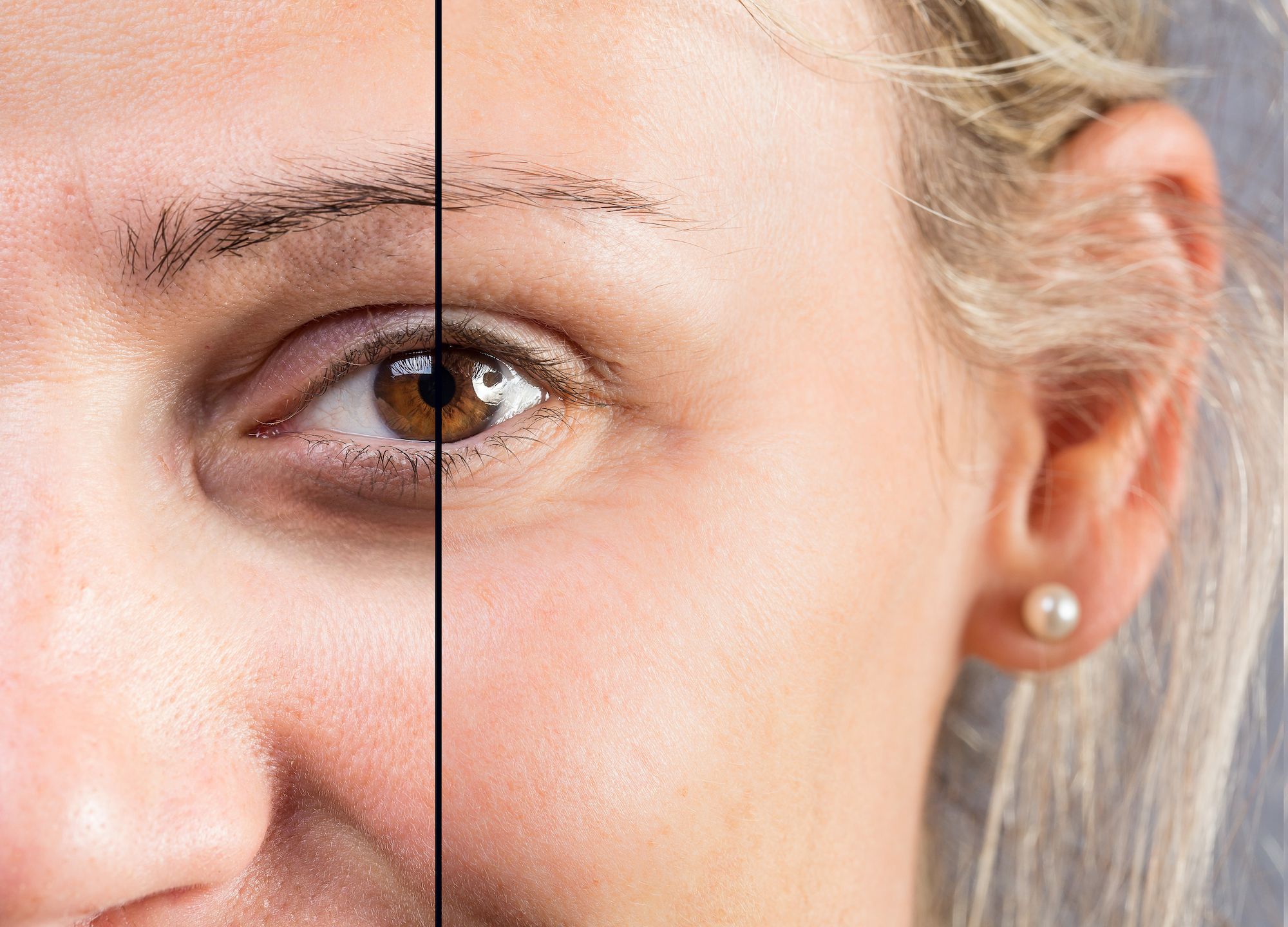 Before-After-Dark-Circles-Stock-Photo