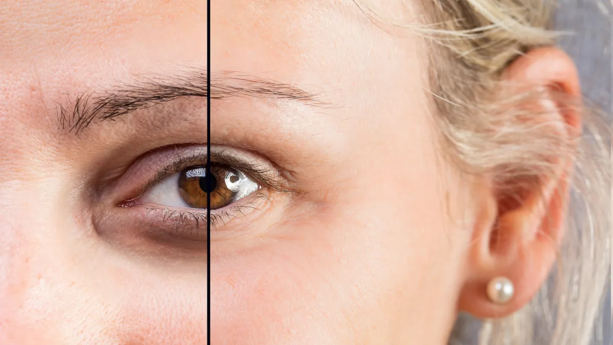 Before-After-Dark-Circles-Stock-Photo