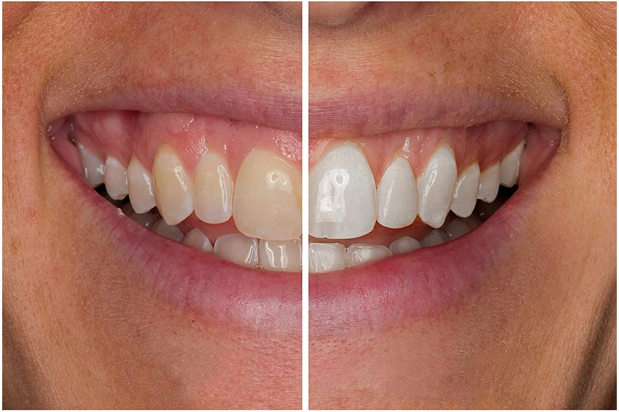 Snow Teeth Whitening Kit with LED Light