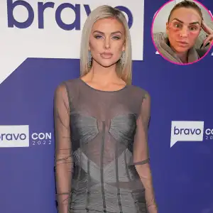 'Vanderpump Rules' Star Lala Kent Shares Photo of Her Bruised Face After Microneedling Procedure - 196